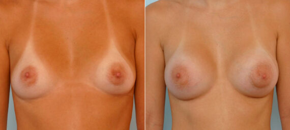Breast Augmentation before and after photos in Houston, TX, Patient 25852
