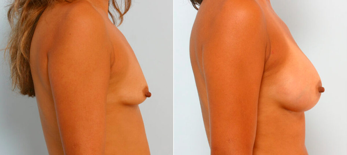 Breast Augmentation before and after photos in Houston, TX, Patient 25859