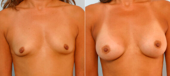 Breast Augmentation before and after photos in Houston, TX, Patient 25859