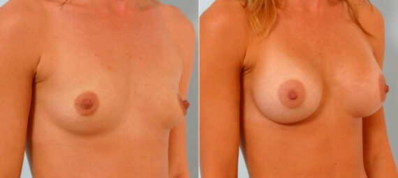 Breast Augmentation before and after photos in Houston, TX, Patient 25866