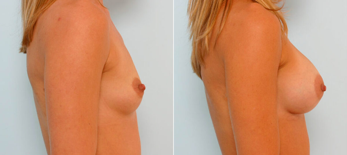 Breast Augmentation before and after photos in Houston, TX, Patient 25866