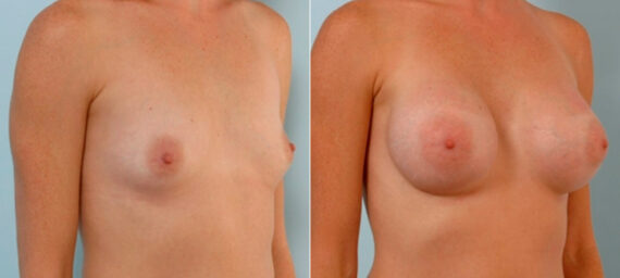 Breast Augmentation before and after photos in Houston, TX, Patient 25873