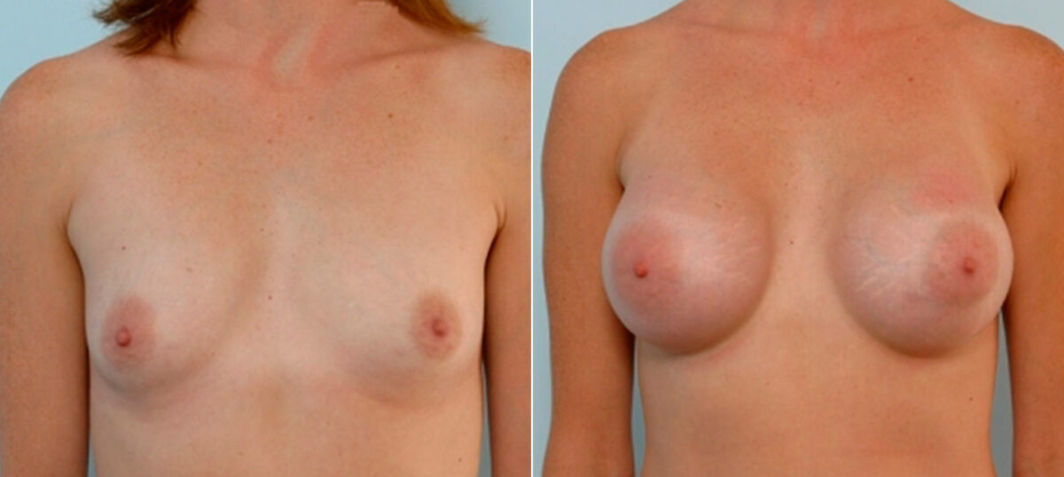 Breast Augmentation before and after photos in Houston, TX, Patient 25873