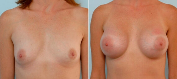 Breast Augmentation before and after photos in Houston, TX, Patient 25873