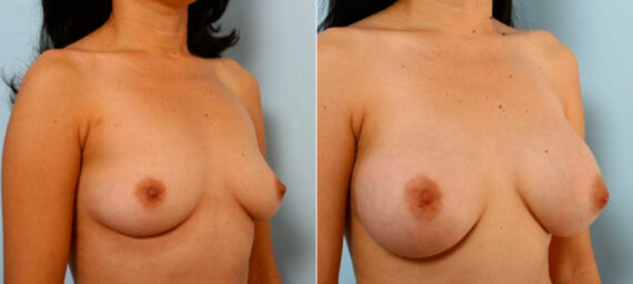 Breast Augmentation before and after photos in Houston, TX, Patient 25880