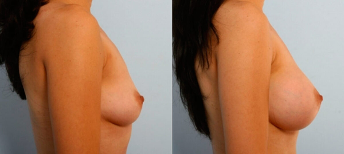 Breast Augmentation before and after photos in Houston, TX, Patient 25880