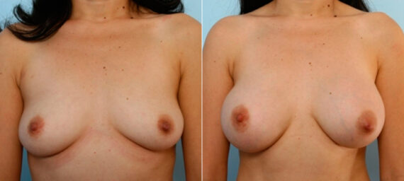 Breast Augmentation before and after photos in Houston, TX, Patient 25880