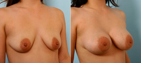 Breast Augmentation before and after photos in Houston, TX, Patient 25891
