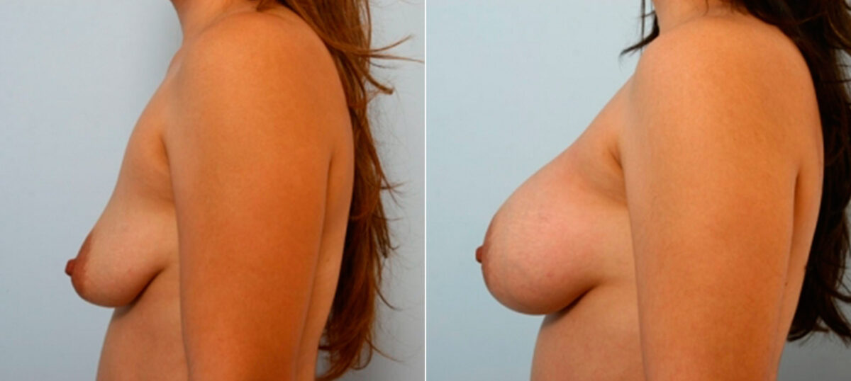 Breast Augmentation before and after photos in Houston, TX, Patient 25891