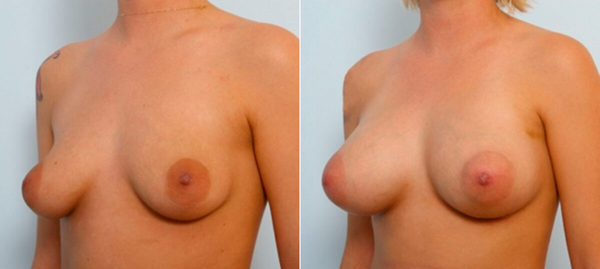 Breast Augmentation before and after photos in Houston, TX, Patient 25902