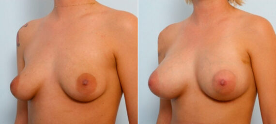 Breast Augmentation before and after photos in Houston, TX, Patient 25902