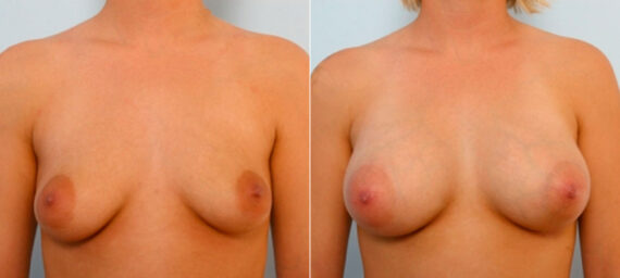 Breast Augmentation before and after photos in Houston, TX, Patient 25902