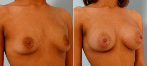 Breast Augmentation before and after photos in Houston, TX, Patient 25909