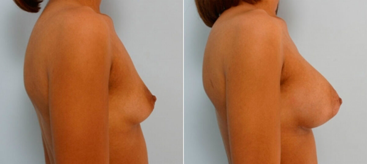 Breast Augmentation before and after photos in Houston, TX, Patient 25909