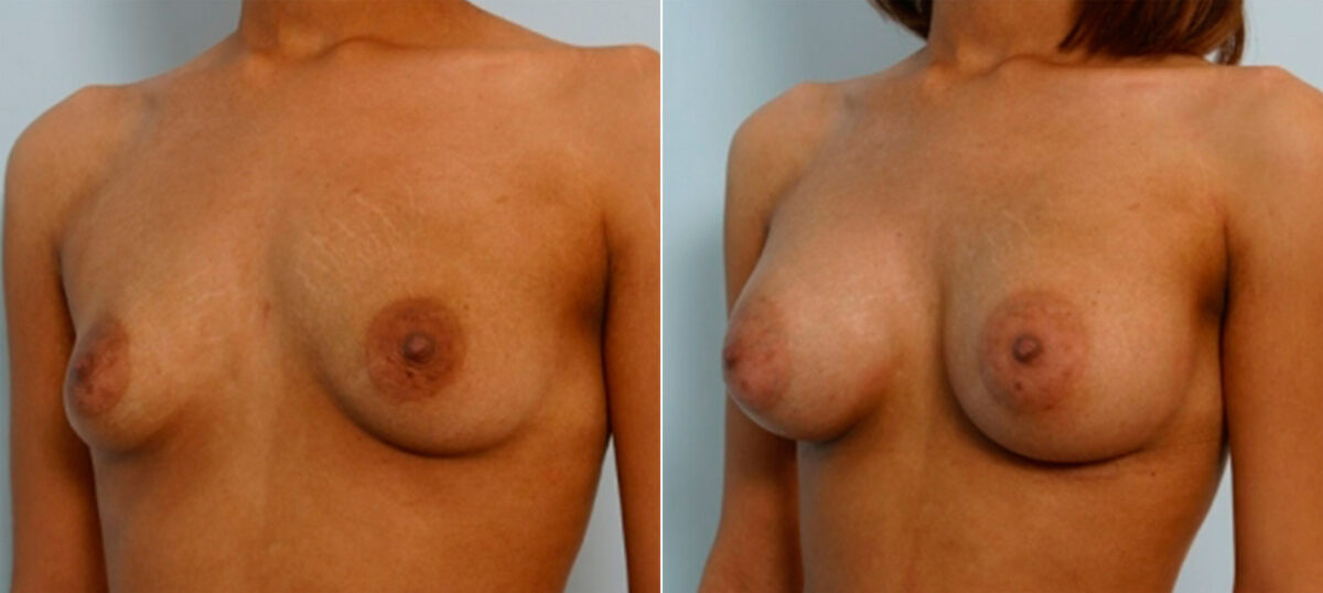 Breast Augmentation before and after photos in Houston, TX, Patient 25909