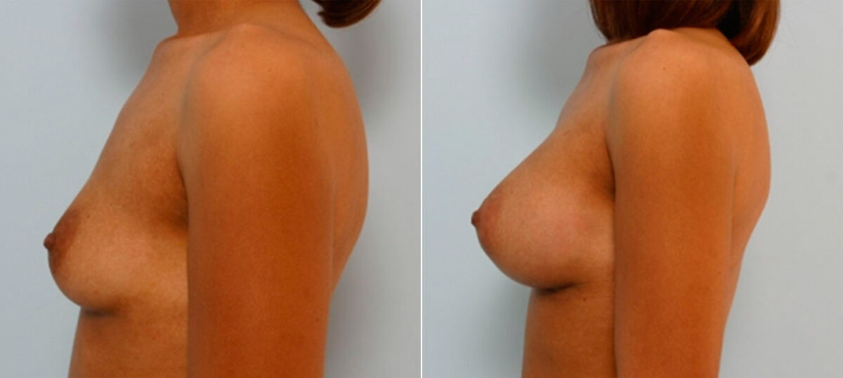 Breast Augmentation before and after photos in Houston, TX, Patient 25909
