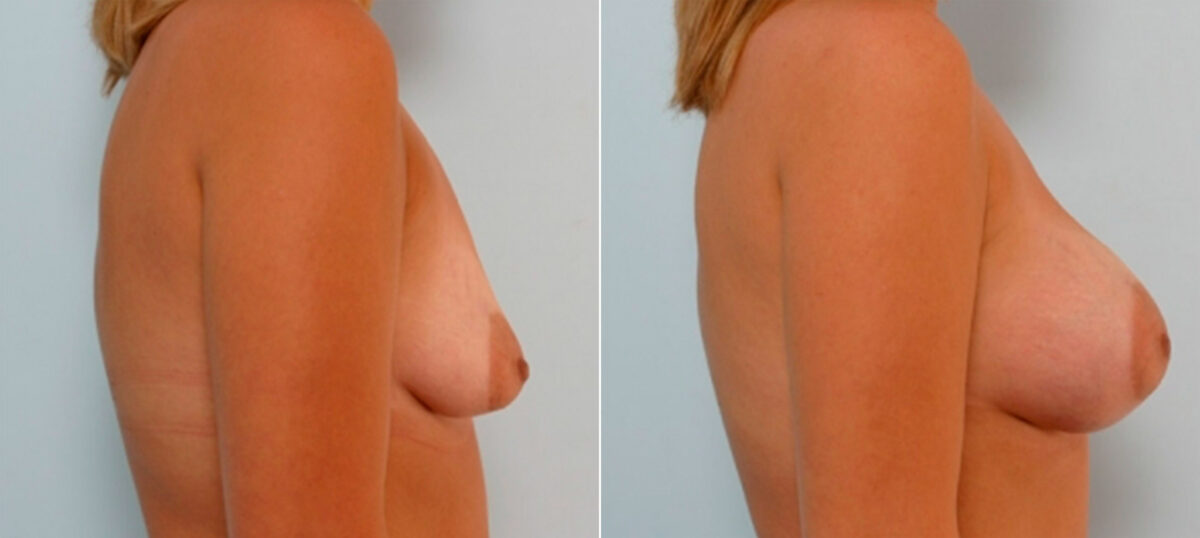 Breast Augmentation before and after photos in Houston, TX, Patient 25920