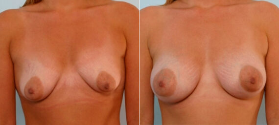 Breast Augmentation before and after photos in Houston, TX, Patient 25920