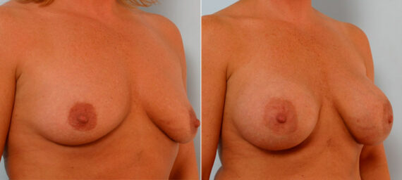 Breast Augmentation before and after photos in Houston, TX, Patient 25927