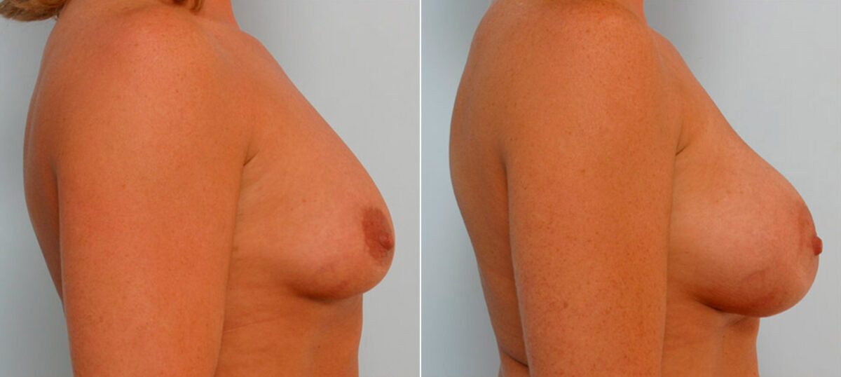 Breast Augmentation before and after photos in Houston, TX, Patient 25927
