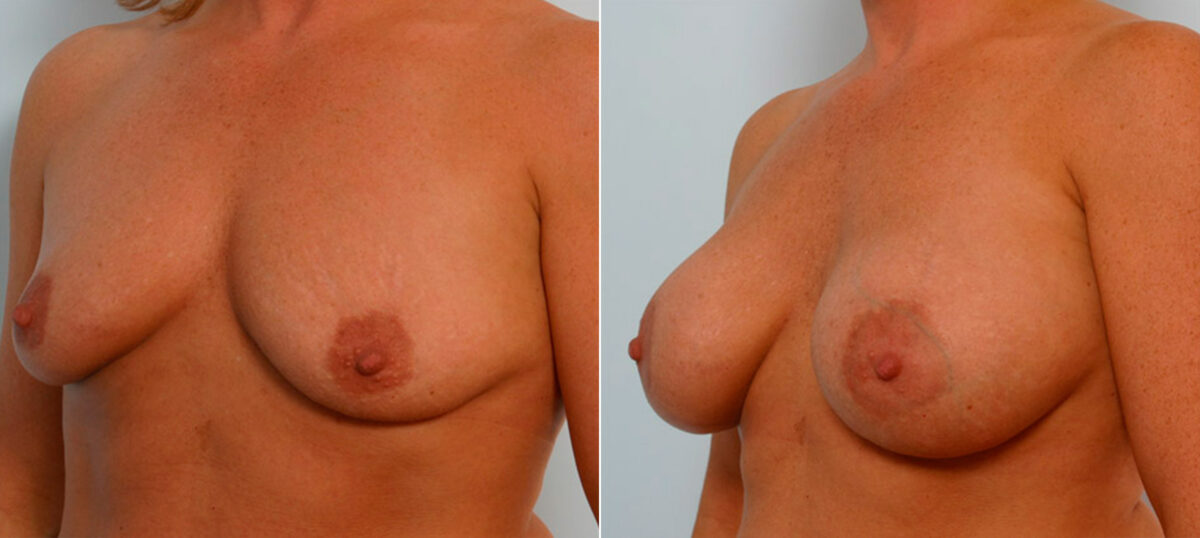 Breast Augmentation before and after photos in Houston, TX, Patient 25927