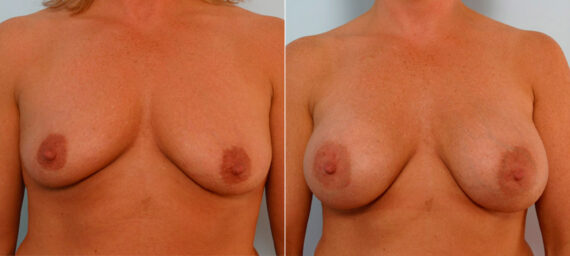 Breast Augmentation before and after photos in Houston, TX, Patient 25927