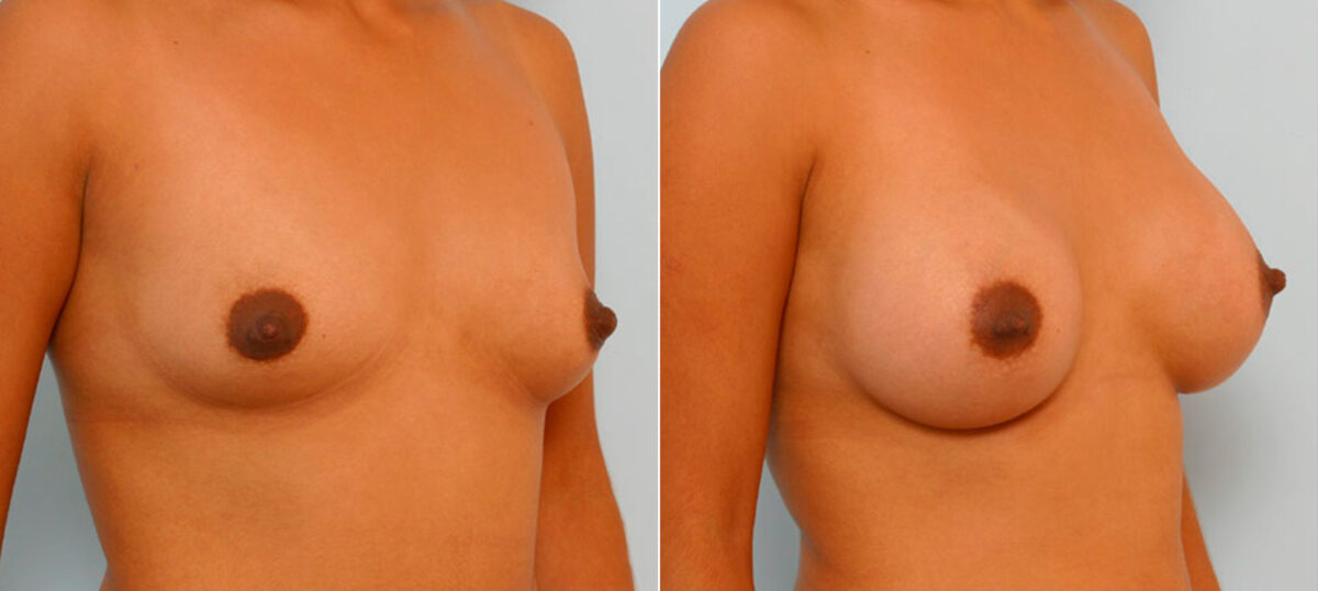 Breast Augmentation before and after photos in Houston, TX, Patient 25938