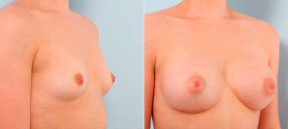 Breast Augmentation before and after photos in Houston, TX, Patient 25945