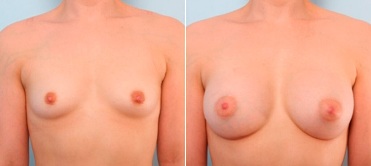 Patient 25945, Breast Augmentation before and after photos Breast Augmentation before and after photos in Houston, TX, Patient 25945