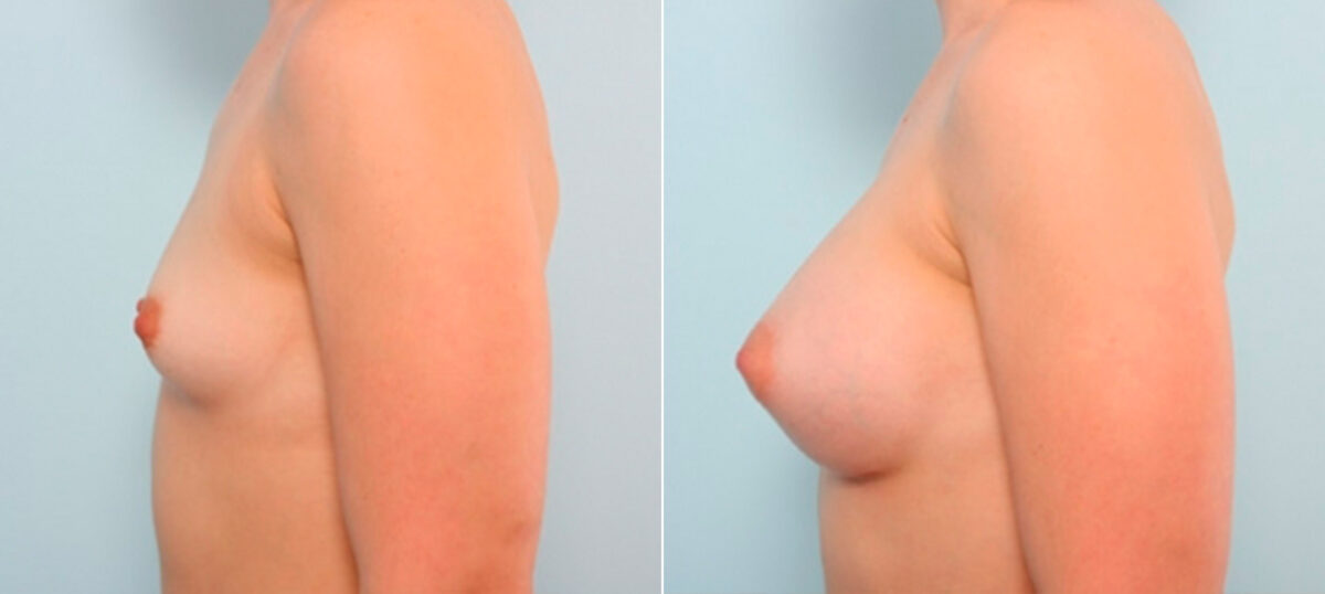 Breast Augmentation before and after photos in Houston, TX, Patient 25945