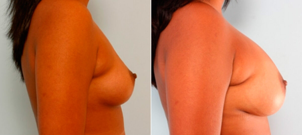 Breast Augmentation before and after photos in Houston, TX, Patient 25967