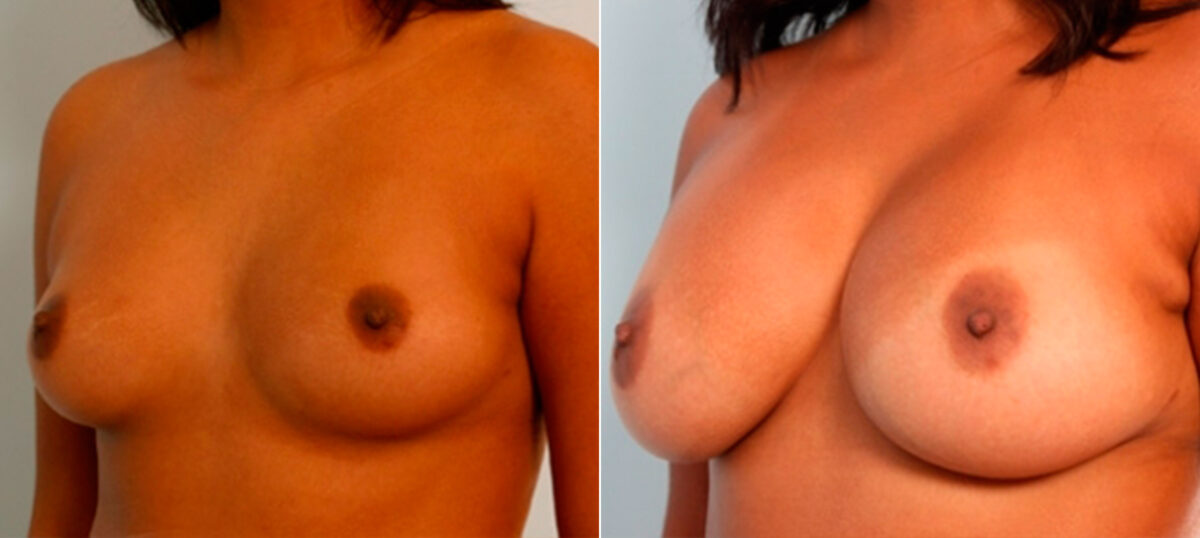 Breast Augmentation before and after photos in Houston, TX, Patient 25967