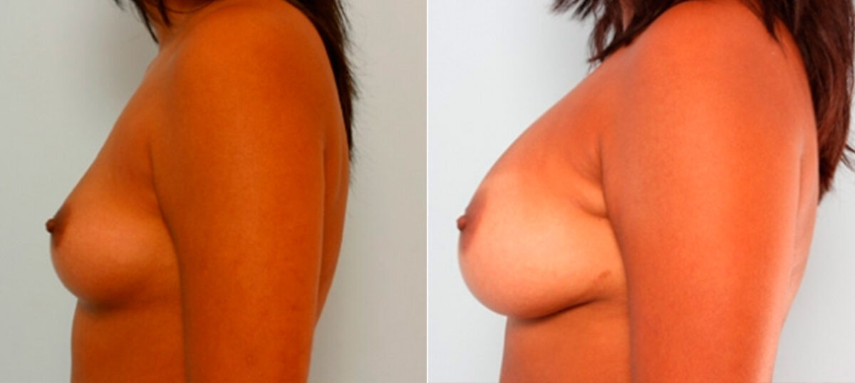 Breast Augmentation before and after photos in Houston, TX, Patient 25967