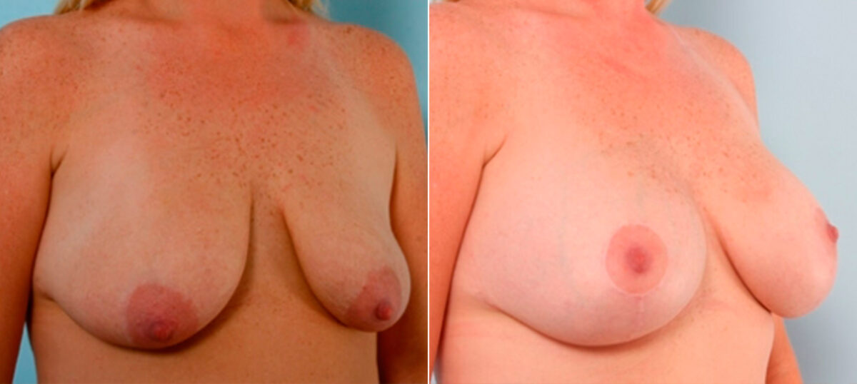 Breast Augmentation before and after photos in Houston, TX, Patient 25978