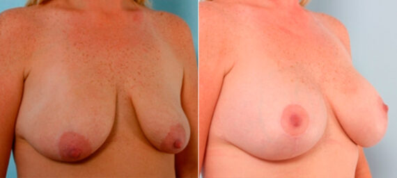 Breast Augmentation before and after photos in Houston, TX, Patient 25978