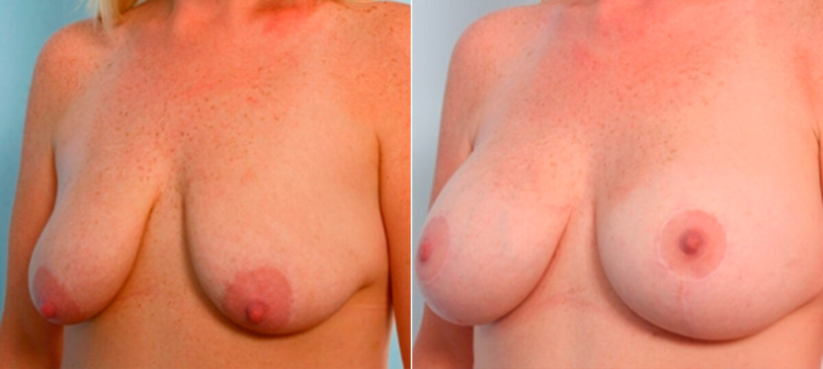 Breast Augmentation before and after photos in Houston, TX, Patient 25978