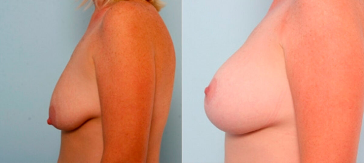 Breast Augmentation before and after photos in Houston, TX, Patient 25978