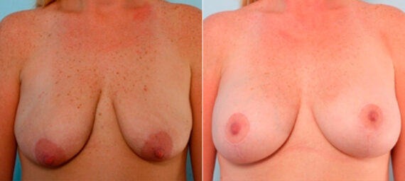 Breast Augmentation before and after photos in Houston, TX, Patient 25978