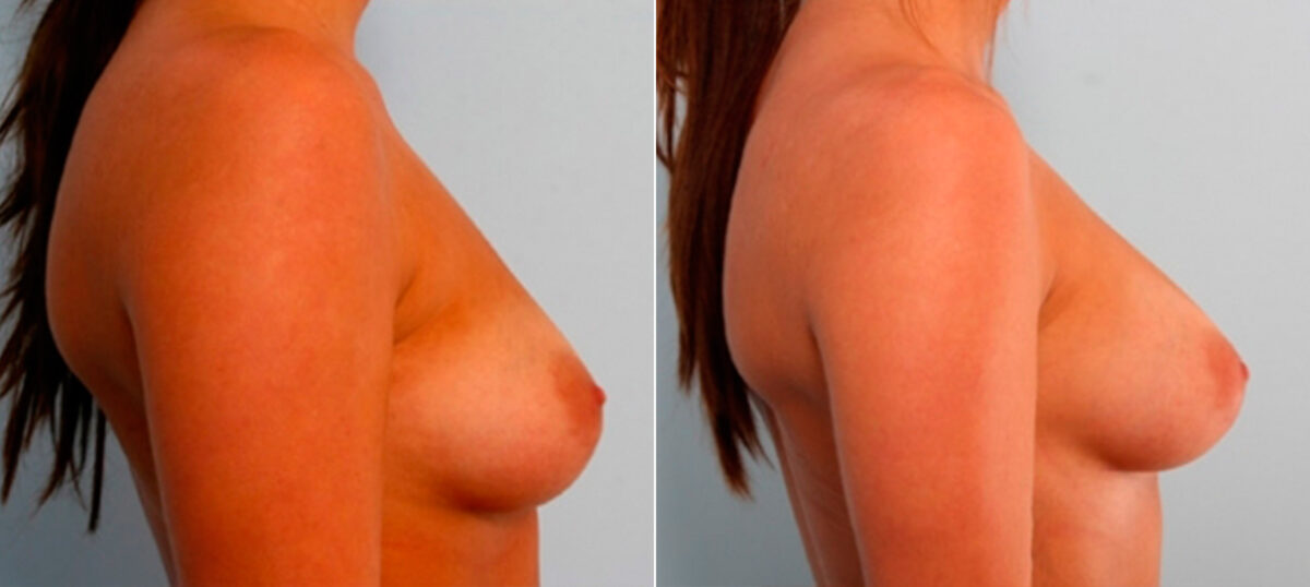 Breast Augmentation before and after photos in Houston, TX, Patient 25989