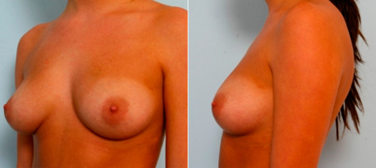 Breast Augmentation before and after photos in Houston, TX, Patient 25989