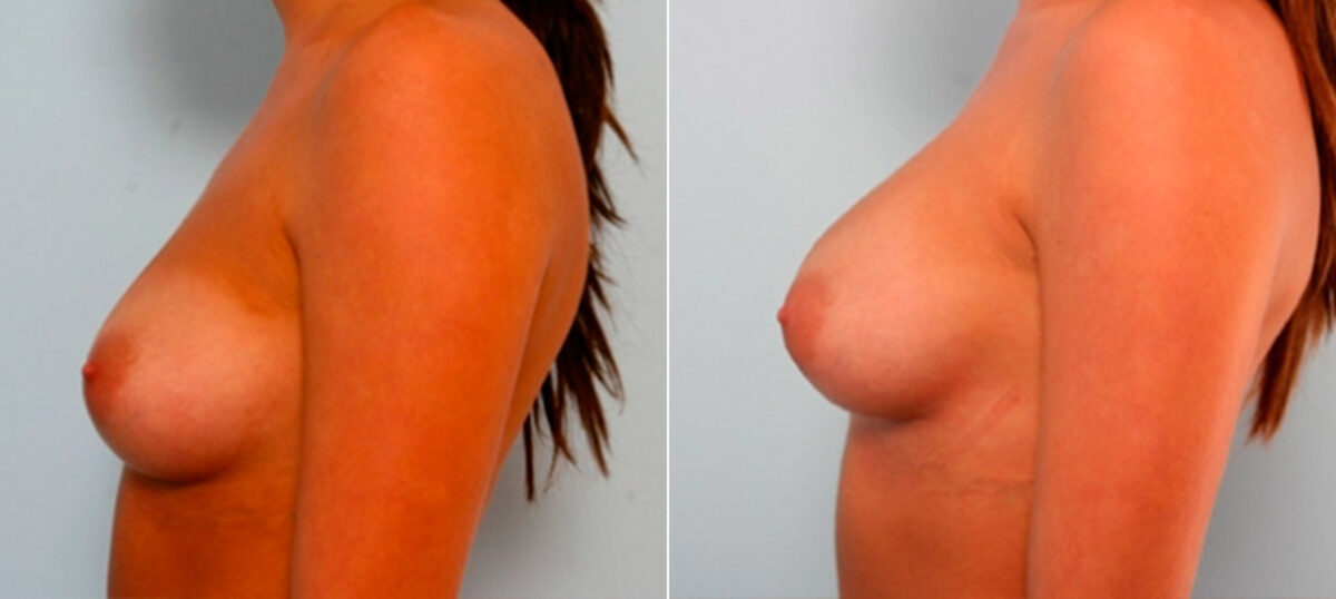 Breast Augmentation before and after photos in Houston, TX, Patient 25989