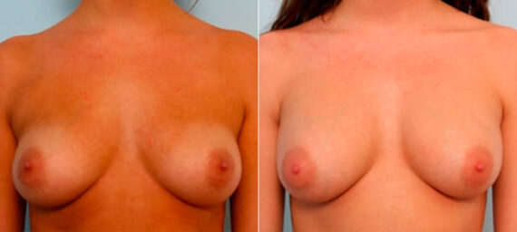 Breast Augmentation before and after photos in Houston, TX, Patient 25989