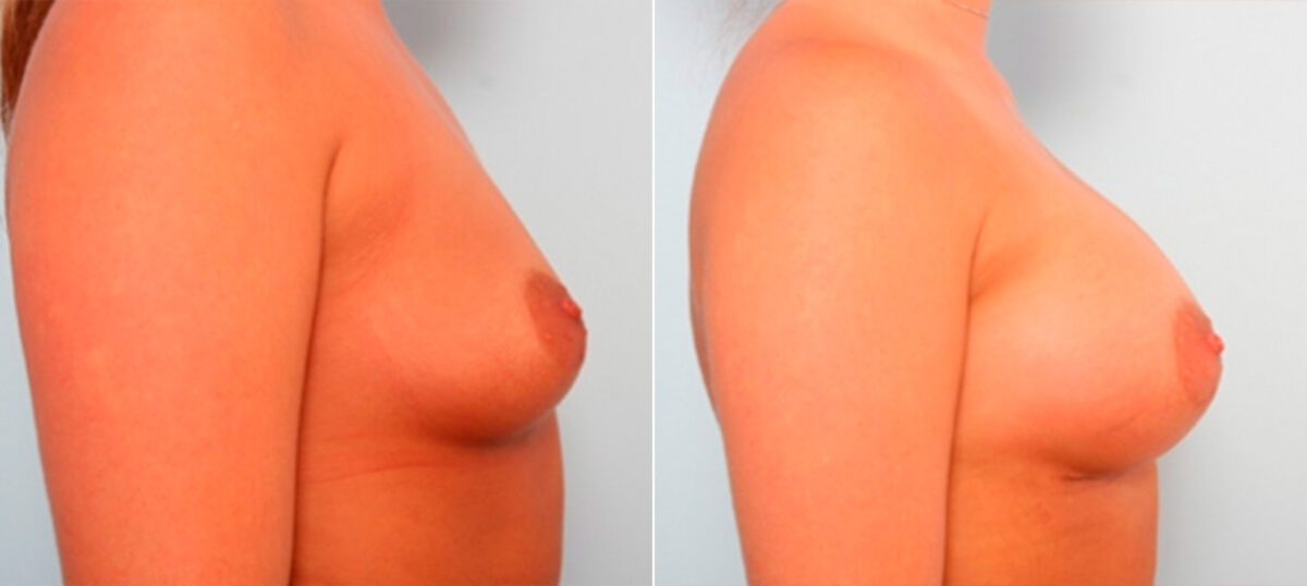 Breast Augmentation before and after photos in Houston, TX, Patient 26000