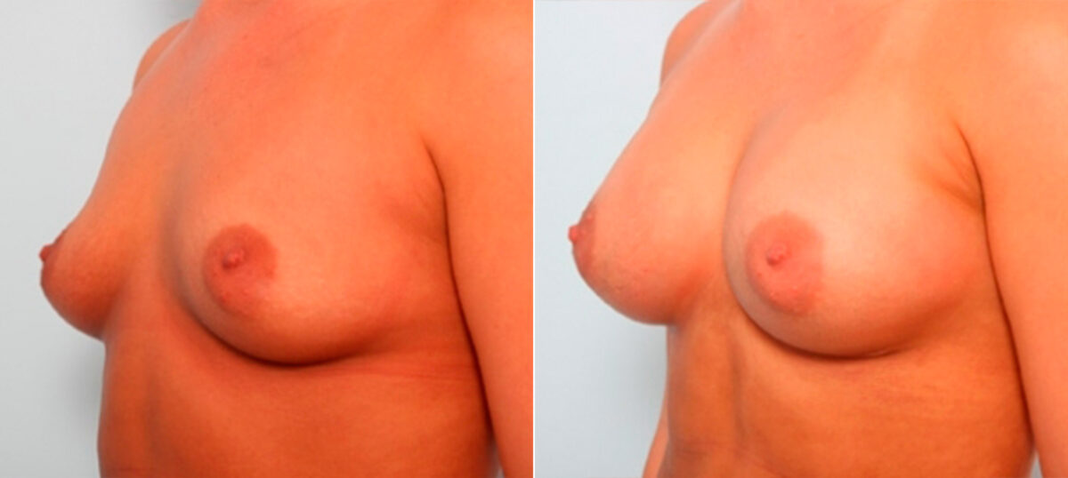 Breast Augmentation before and after photos in Houston, TX, Patient 26000