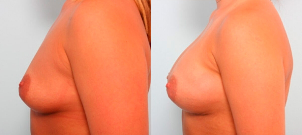 Breast Augmentation before and after photos in Houston, TX, Patient 26000