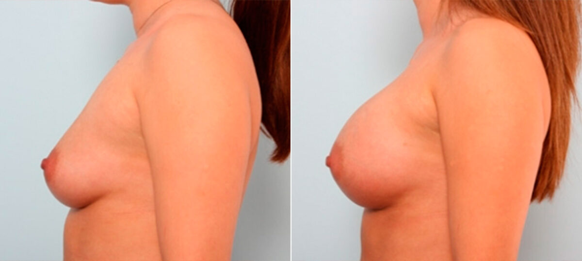 Breast Augmentation before and after photos in Houston, TX, Patient 26011