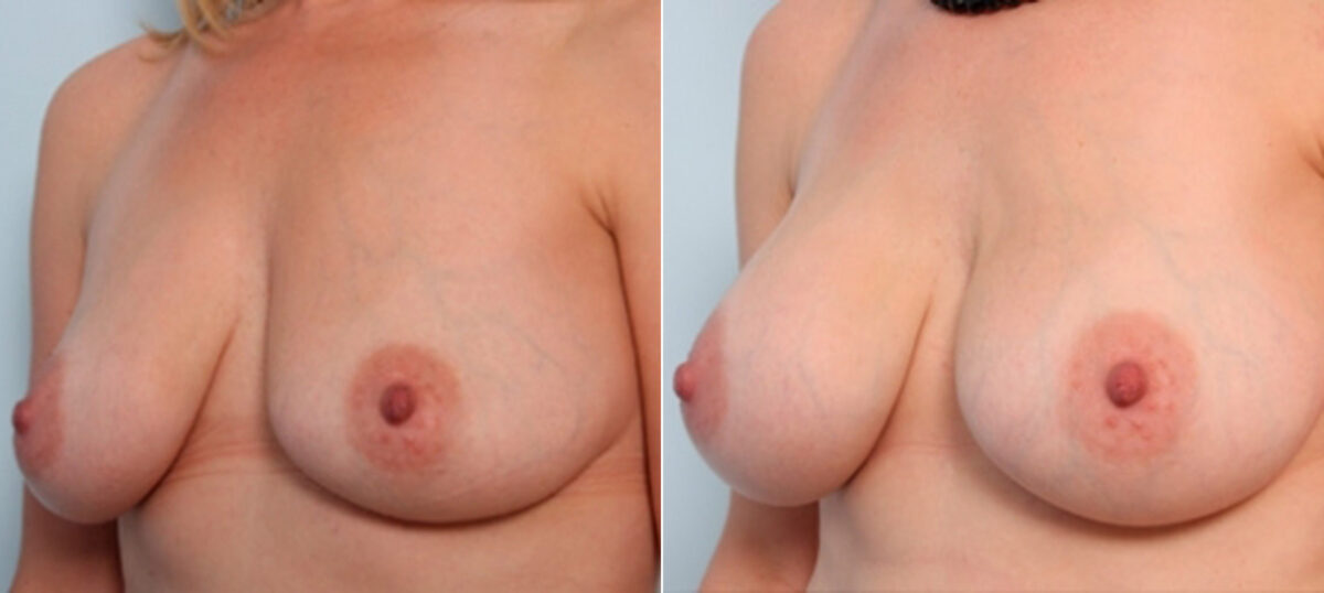Breast Augmentation before and after photos in Houston, TX, Patient 26022