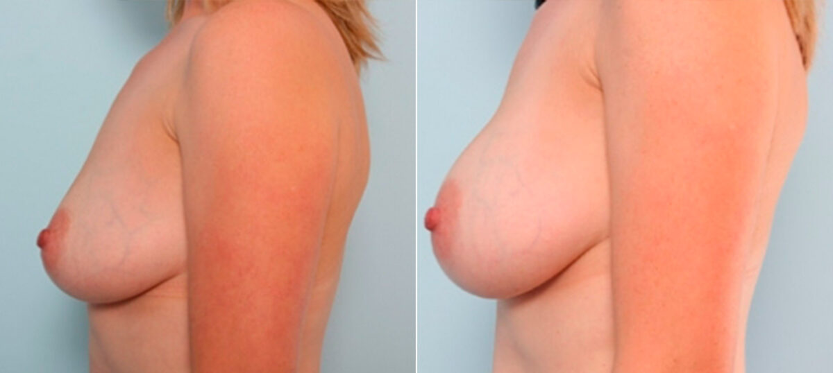 Breast Augmentation before and after photos in Houston, TX, Patient 26022