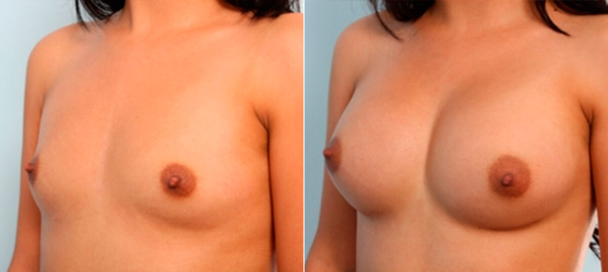 Breast Augmentation before and after photos in Houston, TX, Patient 26033