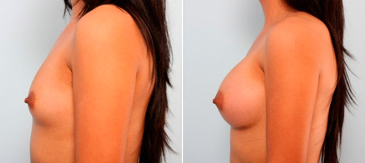 Breast Augmentation before and after photos in Houston, TX, Patient 26033